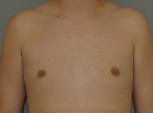 gynecomastia-after