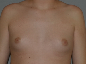 gynecomastia-before