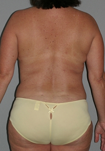 liposuction-after