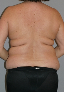 liposuction-before