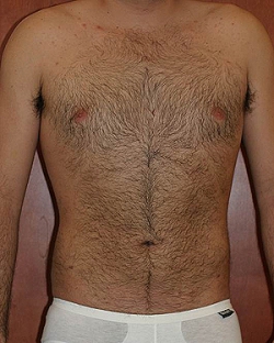 male-lipo-after