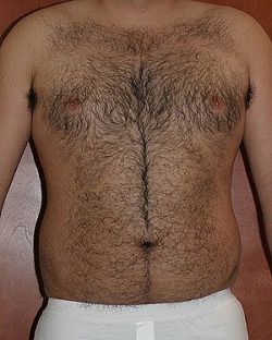 male-lipo-before