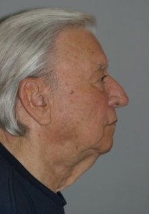 male-necklift-before