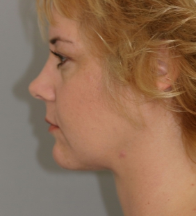 neck-lift-after