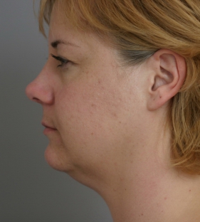 neck-lift-before