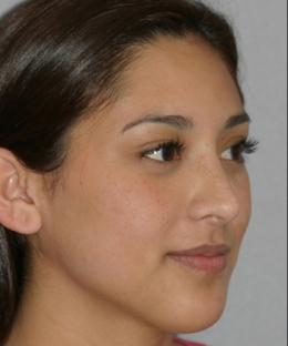 rhinoplasty-after