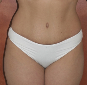tummy-tuck-after