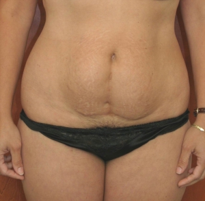 tummy-tuck-before